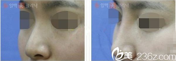韓國一脈美注射隆鼻
