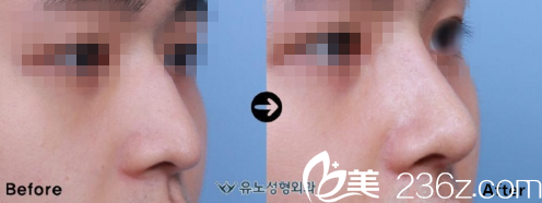 駝峰鼻矯正前后對比