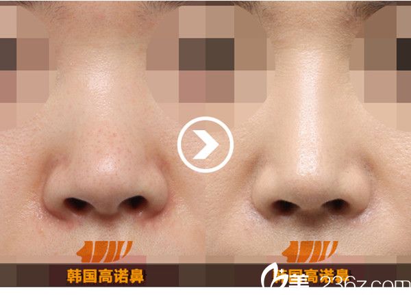 韓國(guó)高諾鼻CONOPI整形外科醫(yī)院隆鼻案例 韓國(guó)高諾鼻CONOPI整形外科醫(yī)院隆鼻案例