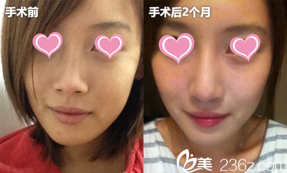 韓國(guó)高諾鼻CONOPI整形外科醫(yī)院隆鼻安利了 韓國(guó)高諾鼻CONOPI整形外科醫(yī)院隆鼻安利了