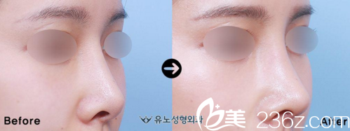 鼻整形前后效果對(duì)比 鼻整形前后效果對(duì)比