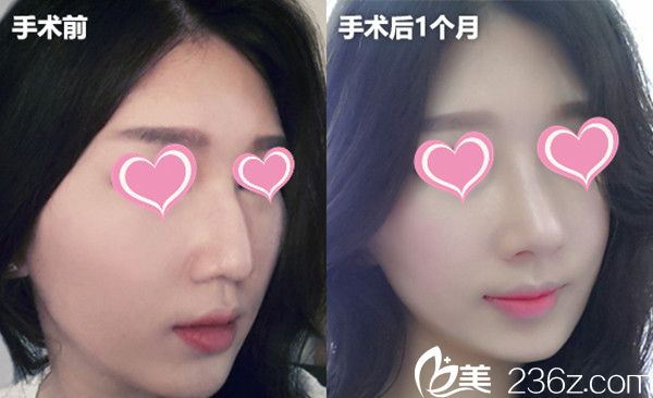 鄭太英院長隆鼻手術(shù)真人案例 鄭太英院長隆鼻手術(shù)真人案例