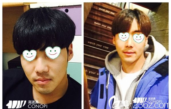 林志賢院長(zhǎng)隆鼻手術(shù)真人案例 林志賢院長(zhǎng)隆鼻手術(shù)真人案例