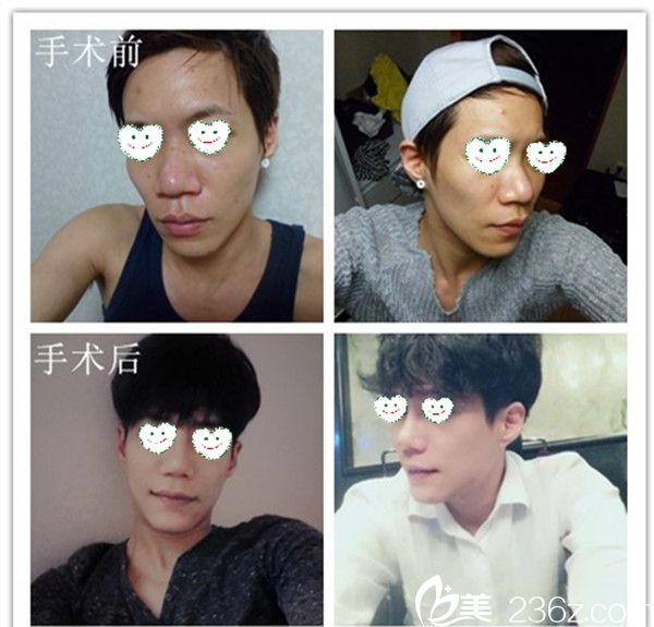 韓國高諾鼻CONOPI整形外科醫(yī)院案例