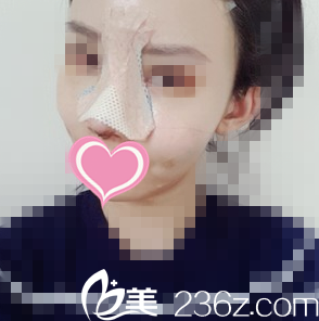 鼻整形術(shù)后3天 鼻整形術(shù)后3天