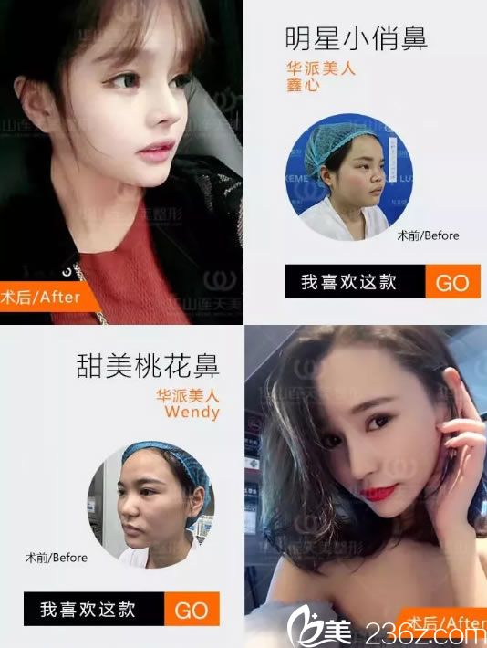 杭州連天美隆鼻手術案例