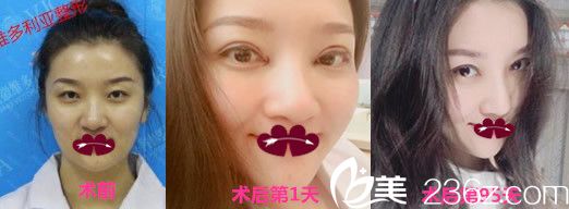 維多利亞徐和林雙眼皮整形怎么樣？看全切雙眼皮整形案例效果圖