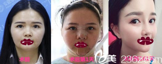 資深整形醫(yī)生徐和林鼻綜合隆鼻+下頜角整形案例恢復(fù)效果圖展示