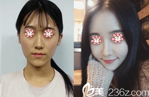 白衡翼院長自體脂肪面部填充案例