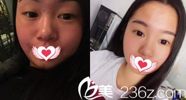 去安徽維多利亞整形外科醫(yī)院找吳麗麗醫(yī)生做全切雙眼皮案例前后對(duì)比照 去安徽維多利亞整形外科醫(yī)院找吳麗麗醫(yī)生做全切雙眼皮案例前后對(duì)比照