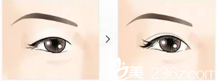 北京亞楠容悅醫(yī)療美容診所開眼角效果示意圖 北京亞楠容悅醫(yī)療美容診所開眼角效果示意圖