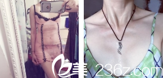 胸部術(shù)前圖