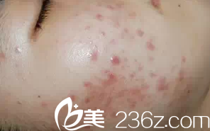 做激光祛痘術(shù)前照片 做激光祛痘術(shù)前照片