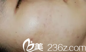 敘述大連美女在韓國海德仁皮膚醫(yī)院的激光祛痘之行！