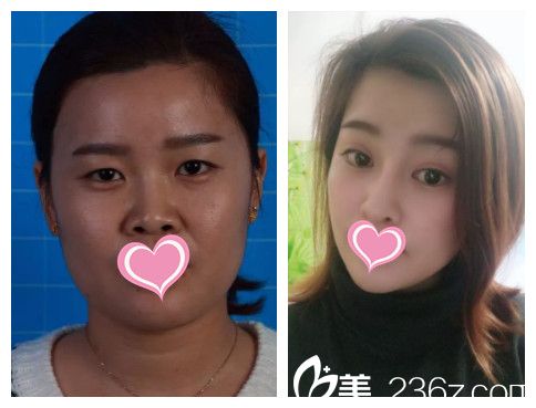 郭東超做雙眼皮案例