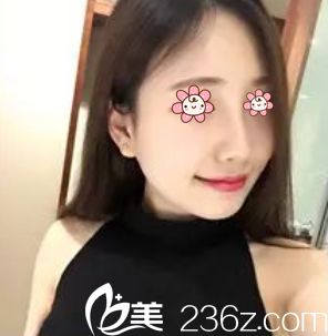 去韓國普瑞美整形約張?jiān)Ｕ涫中g(shù)才知道做個(gè)肋軟骨隆鼻根本不算啥