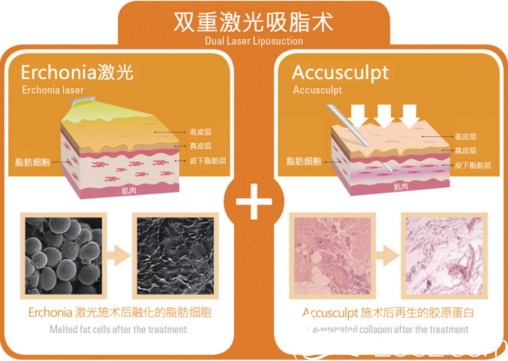 張斗烈研發(fā)的雙重激光吸脂術(shù) 張斗烈研發(fā)的雙重激光吸脂術(shù)