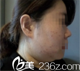 下巴吸脂手術(shù)前 下巴吸脂手術(shù)前