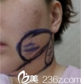 下巴吸脂前畫線 下巴吸脂前畫線