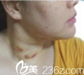 下巴吸脂術(shù)后一周 下巴吸脂術(shù)后一周