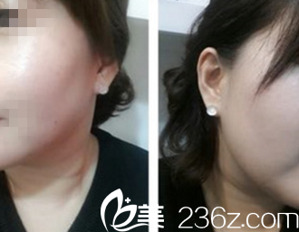 韓國體引脂醫(yī)院張斗烈給我做的雙重激光下巴吸脂術(shù)效果真心很明顯！