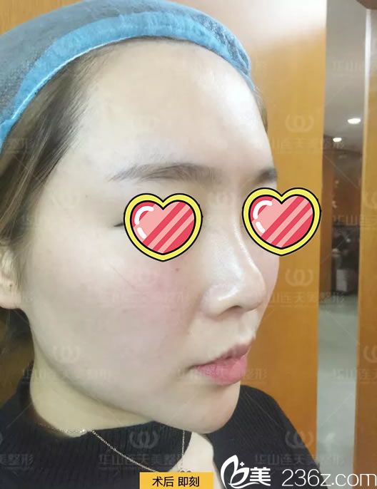 注射玻尿酸填充蘋(píng)果肌和太陽(yáng)穴即刻<span style=