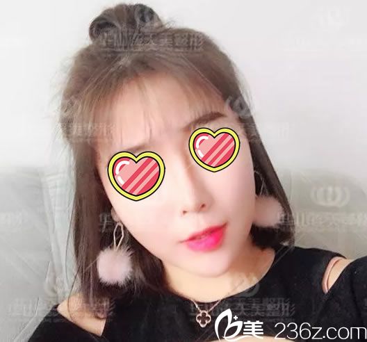 注射玻尿酸填充手術(shù)第1天<span style=