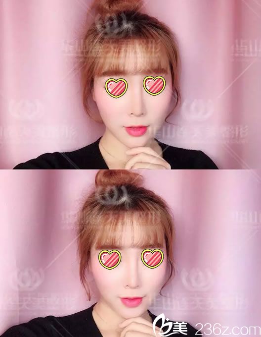 連天美注射玻尿酸第7天恢復(fù)照