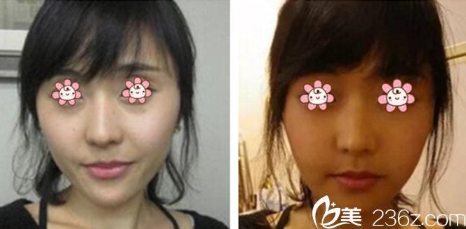 玻尿酸造臥蠶加瘦臉除皺瘦臉 玻尿酸造臥蠶加瘦臉除皺瘦臉