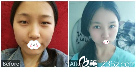 廣州美萊雷濤博士做的雙眼皮案例 廣州美萊雷濤博士做的雙眼皮案例