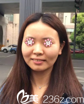 在去韓國麗穎整形外科之前的我 在去韓國麗穎整形外科之前的我