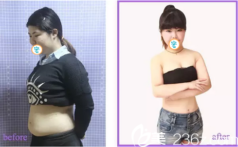 在宜賓韓美做360°環(huán)形吸脂已經(jīng)1個月了 講講我瘦臉瘦腰的親身經(jīng)歷