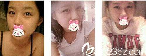 鄭州柏麗芙眼部整形術前 鄭州柏麗芙眼部整形術前