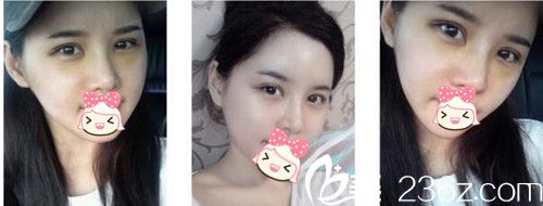 鄭州柏麗芙眼部整形術后3天 鄭州柏麗芙眼部整形術后3天