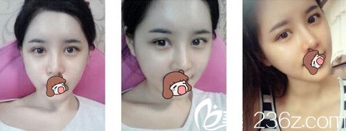 柏麗芙眼部整形后1個月 柏麗芙眼部整形后1個月