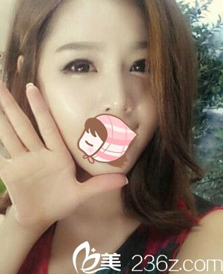 鄭州柏麗芙眼部整形案例 鄭州柏麗芙眼部整形案例