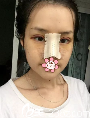 高國(guó)鎮(zhèn)院長(zhǎng)給我做完手術(shù)了