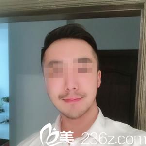 武漢伽美整形玻尿酸墊下巴真實體驗 看了前后對比圖就知道效果咋樣