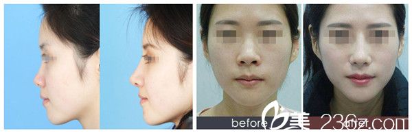 孫蘭娟主任做鼻綜合手術(shù)案例