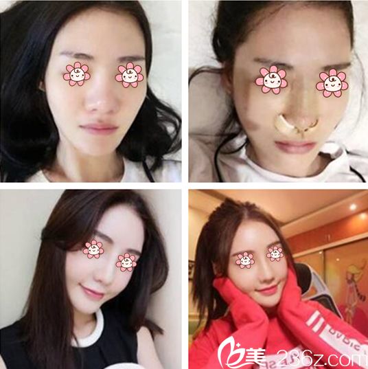 金善球院長鼻整形案例 金善球院長鼻整形案例