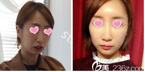 韓國(guó)史丹利皮膚整形醫(yī)院自體脂肪填充案例 韓國(guó)史丹利皮膚整形醫(yī)院自體脂肪填充案例