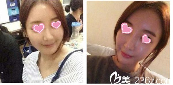 李恩錫院長埋線提升整形手術(shù)真人案例 李恩錫院長埋線提升整形手術(shù)真人案例