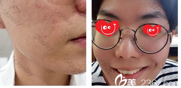 姜仁湖點(diǎn)陣激光去疤痕真人案例 姜仁湖點(diǎn)陣激光去疤痕真人案例