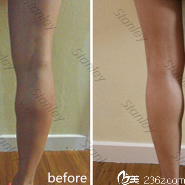 尹珍惠院長瘦腿真人案例 尹珍惠院長瘦腿真人案例