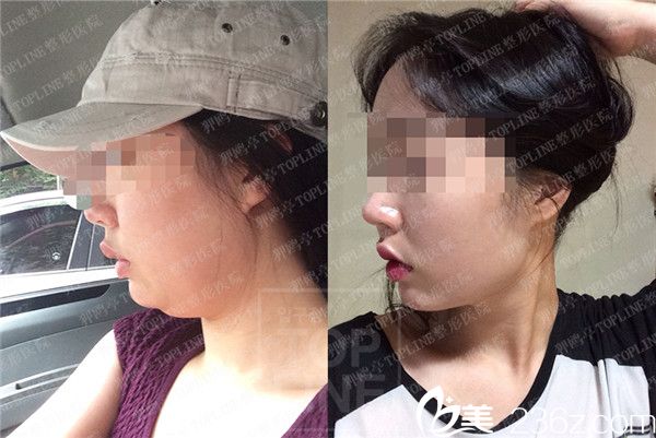 韓國狎鷗亭TOPLINE整形醫(yī)院臉部吸脂案例 韓國狎鷗亭TOPLINE整形醫(yī)院臉部吸脂案例