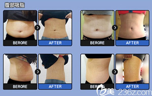 卞相國院長腰部吸脂手術(shù)真人案例 卞相國院長腰部吸脂手術(shù)真人案例