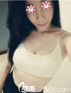 找到一實在關系我就在韓國Cream整形外科做了200CC自體脂肪隆胸