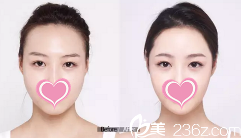 脂肪面部填充前后對比 脂肪面部填充前后對比