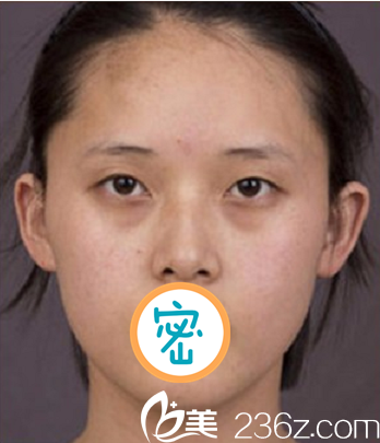 術(shù)前單眼皮小眼睛 術(shù)前單眼皮小眼睛