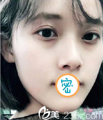 彭太平光子刀雙眼皮手術(shù)打造靈動(dòng)雙眼 術(shù)后恢復(fù)全紀(jì)錄 